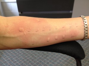 Allergy testing hives